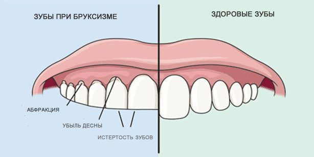 Hampaiden hiominen: Terveet hampaat ja hampaiden aikana bruxism