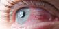 Konjunktiviitti: miksi kostuttakaa silmät ja miten kohdella heitä