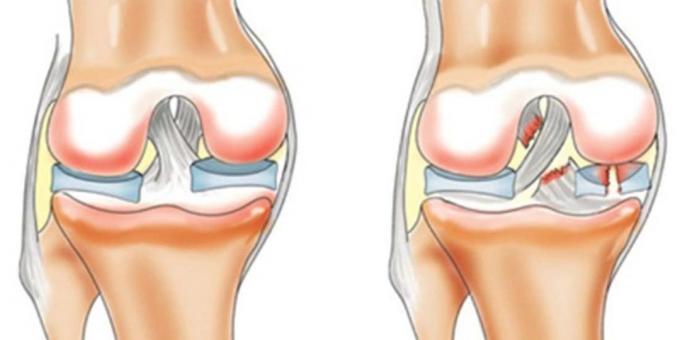 Miksi satuttaa polvet: anterior cruciate ligament repeämä