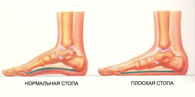 harjoituksia tasainen jalat: normaali ja tasainen jalka