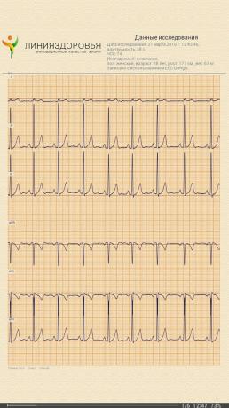 EKG