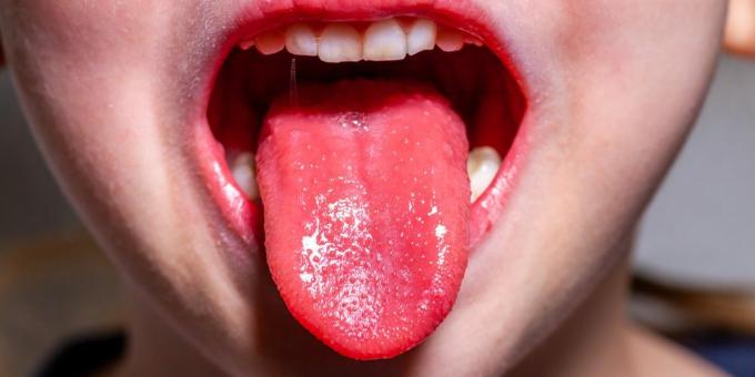 Scarlet-kuumeen oireet: Mansikan kieli