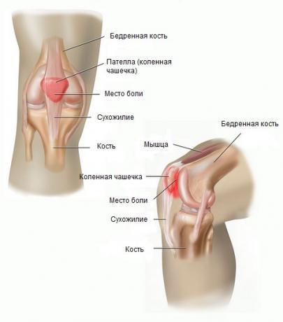 patellofemoral kipuoireyhtymä