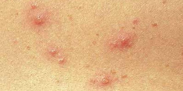 Oireita vesirokko lapsilla ja aikuisilla: Aika usein iho heti näyttävät pieniltä punaisia ​​pisteitä