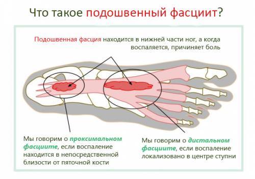 jalkapohjien fasciitis